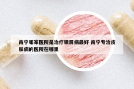 南宁哪家医院是治疗银屑病最好 南宁专治皮肤病的医院在哪里