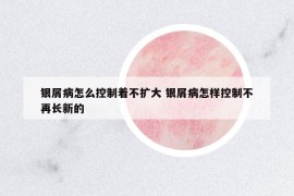 银屑病怎么控制着不扩大 银屑病怎样控制不再长新的