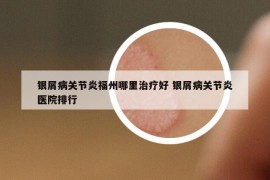 银屑病关节炎福州哪里治疗好 银屑病关节炎医院排行