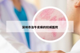 深圳市治牛皮癣的权威医院