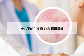 十八岁的牛皮癣 18岁得银屑病