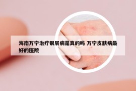 海南万宁治疗银屑病是真的吗 万宁皮肤病最好的医院
