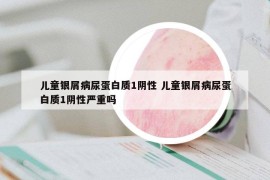 儿童银屑病尿蛋白质1阴性 儿童银屑病尿蛋白质1阴性严重吗