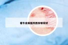 看牛皮癣医院西安哪家好