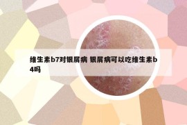 维生素b7对银屑病 银屑病可以吃维生素b4吗