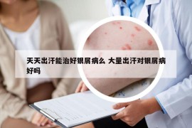 天天出汗能治好银屑病么 大量出汗对银屑病好吗
