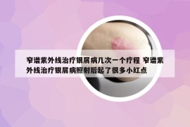窄谱紫外线治疗银屑病几次一个疗程 窄谱紫外线治疗银屑病照射后起了很多小红点