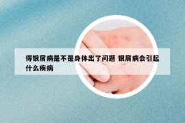 得银屑病是不是身体出了问题 银屑病会引起什么疾病