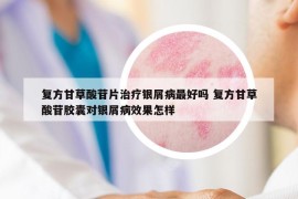 复方甘草酸苷片治疗银屑病最好吗 复方甘草酸苷胶囊对银屑病效果怎样