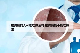 银屑病的人可以吃绿豆吗 银屑病能不能吃绿豆