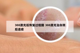 308激光后恢复过程图 308激光治白斑后遗症