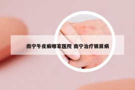 南宁牛皮癣哪家医院 南宁治疗银屑病