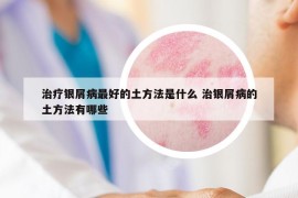 治疗银屑病最好的土方法是什么 治银屑病的土方法有哪些