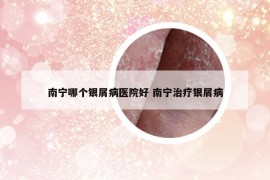 南宁哪个银屑病医院好 南宁治疗银屑病