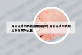 用治湿疹的药能治银屑病吗 用治湿疹的药能治银屑病吗女性