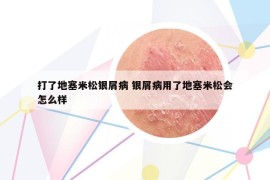 打了地塞米松银屑病 银屑病用了地塞米松会怎么样