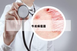 牛皮癣是菌