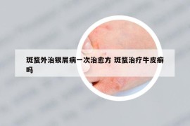 斑蝥外治银屑病一次治愈方 斑蝥治疗牛皮癣吗