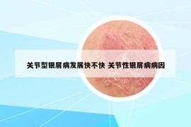 关节型银屑病发展快不快 关节性银屑病病因
