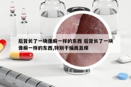 后背长了一块像癣一样的东西 后背长了一块像癣一样的东西,特别干燥而且痒
