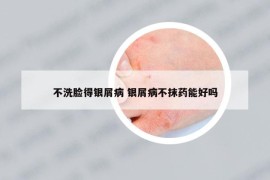 不洗脸得银屑病 银屑病不抹药能好吗