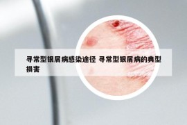 寻常型银屑病感染途径 寻常型银屑病的典型损害