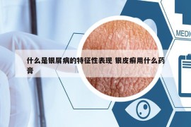 什么是银屑病的特征性表现 银皮癣用什么药膏