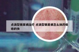 点滴型银屑病浴疗 点滴型银屑病怎么抹药吸收的快
