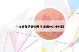 牛皮癣分季节性吗 牛皮癣分几个时期