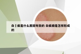 白壂疯是什么原因导致的 白疯癫是怎样形成的