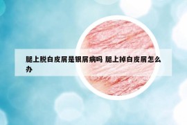 腿上脱白皮屑是银屑病吗 腿上掉白皮屑怎么办