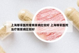上海那家医院看银屑病比较好 上海哪家医院治疗银屑病比较好