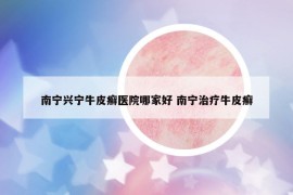 南宁兴宁牛皮癣医院哪家好 南宁治疗牛皮癣