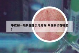 牛皮癣一般长在什么地方呢 牛皮癣长在哪里?