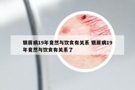 银屑病19年竟然与饮食有关系 银屑病19年竟然与饮食有关系了