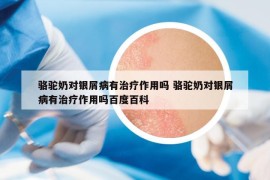 骆驼奶对银屑病有治疗作用吗 骆驼奶对银屑病有治疗作用吗百度百科