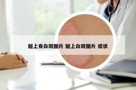 腿上有白斑图片 腿上白斑图片 症状