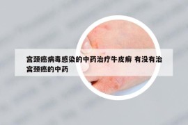 宫颈癌病毒感染的中药治疗牛皮癣 有没有治宫颈癌的中药