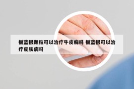 板蓝根颗粒可以治疗牛皮癣吗 板蓝根可以治疗皮肤病吗