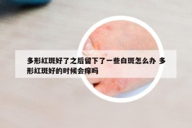 多形红斑好了之后留下了一些白斑怎么办 多形红斑好的时候会痒吗
