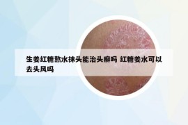 生姜红糖熬水抹头能治头癣吗 红糖姜水可以去头风吗