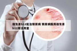 维生素b12能治银屑病 银屑病服用维生素b12用法用量