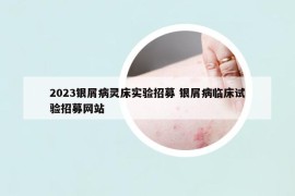 2023银屑病灵床实验招募 银屑病临床试验招募网站