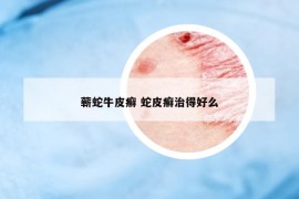 蕲蛇牛皮癣 蛇皮癣治得好么