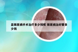 昌银屑病手术治疗多少钱呢 银屑病治好要多少钱
