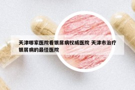 天津哪家医院看银屑病权威医院 天津市治疗银屑病的最佳医院