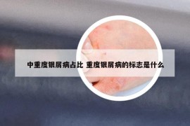 中重度银屑病占比 重度银屑病的标志是什么