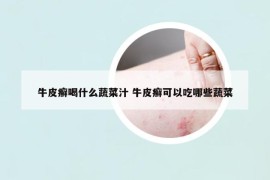 牛皮癣喝什么蔬菜汁 牛皮癣可以吃哪些蔬菜