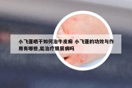 小飞蓬晒干如何治牛皮癣 小飞蓬的功效与作用有哪些,能治疗银屑病吗