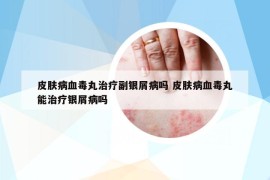 皮肤病血毒丸治疗副银屑病吗 皮肤病血毒丸能治疗银屑病吗